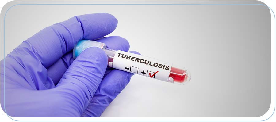 Tuberculosis Testing Near Me in Downtown Long Beach CA, Bixby Knolls Long Beach CA, and Paramount CA.
