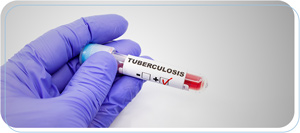 Tuberculosis Testing Near Me in Downtown Long Beach CA, Bixby Knolls Long Beach CA, and Paramount CA.